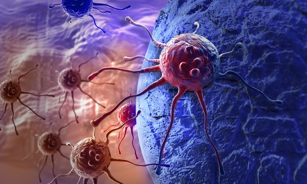 St 107 krebs BILD iStock
