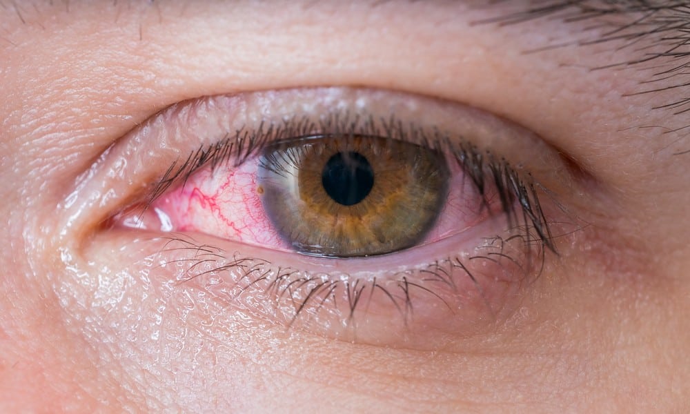 St 79 Auge BILD iStock