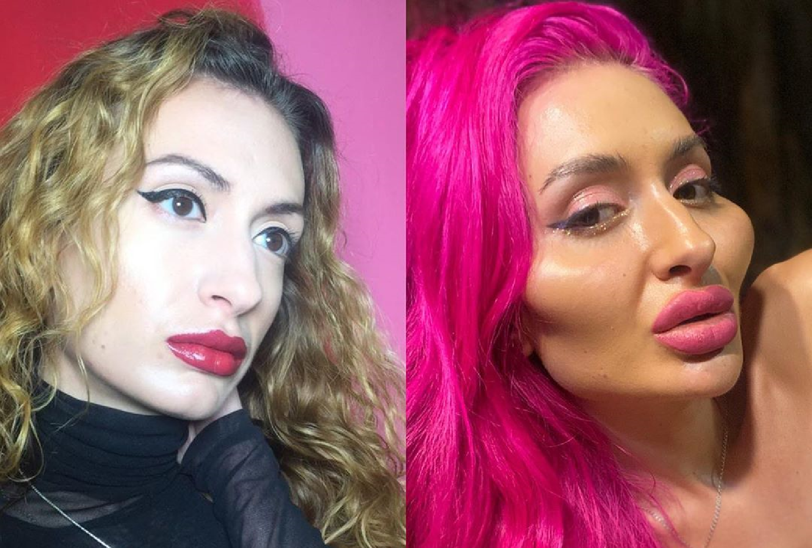 Influencerin mit Mega-Wangen süchtig nach Operationen 72 Vor und nach den Operationen