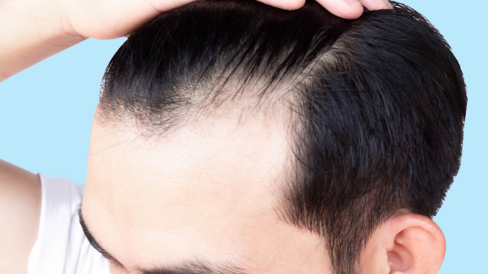 Cola und Energy-Drinks sorgen bei Männern für Haarausfall 61 Haarausfall
